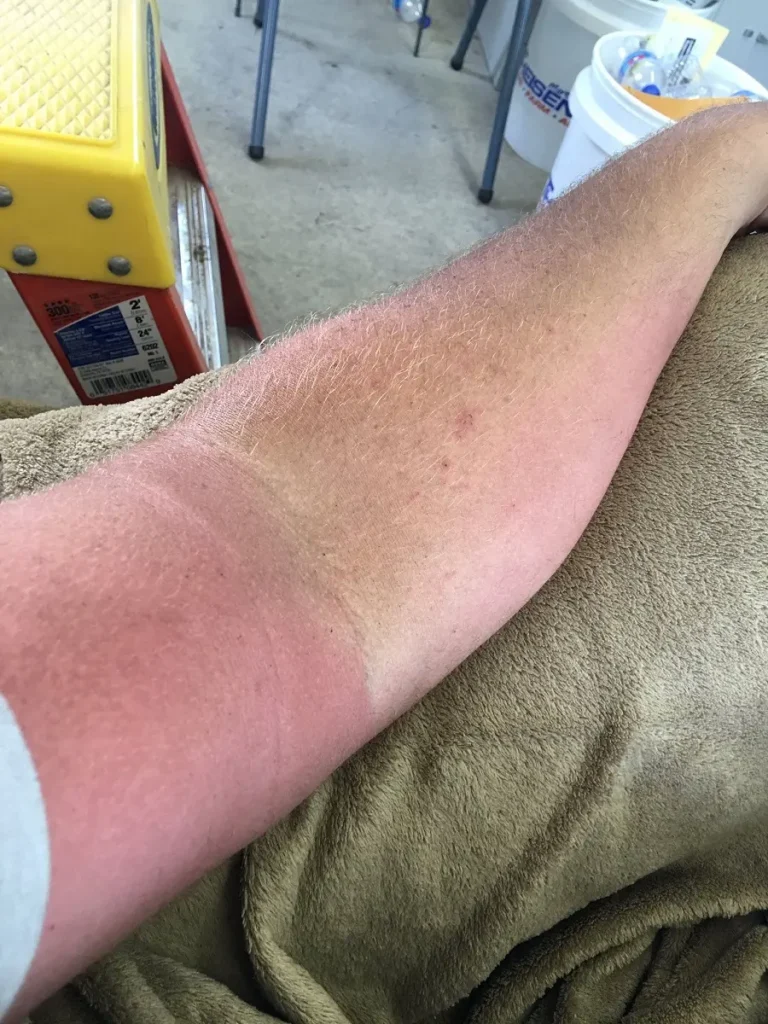 An example of welding sunburn